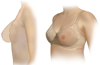 How to Wear a Breast Form - Mastectomy Shop